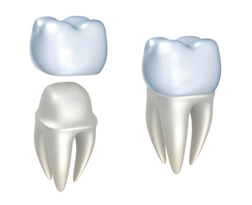 Dental Crowns And Bridges At Your Dentist