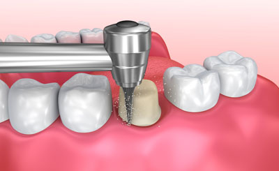 Visit A Restorative Dentist In Dunwoody For Dental Crowns