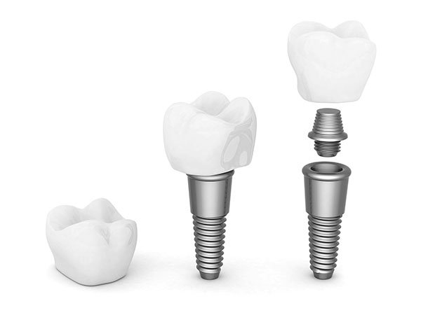 The Impact Of Dental Implants On Your Facial Structure