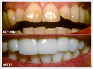 Dunwoody dental veneers before and after pictures