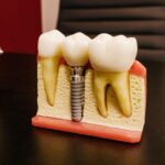 Dental Implant Surgery Recovery: What to Expect Day by Day