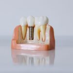What is the Average Cost of Dental Implants in Atlanta? A Full Price Breakdown