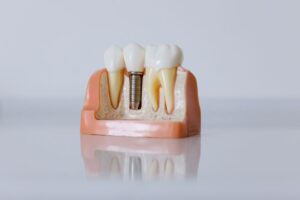 Dentist showing a patient a dental implant model while discussing average cost of dental implants in Atlanta