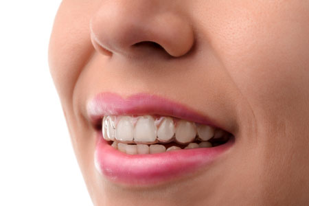 Learn How Teeth Can Be Straightened Invisibly From An Invisalign® Dentist