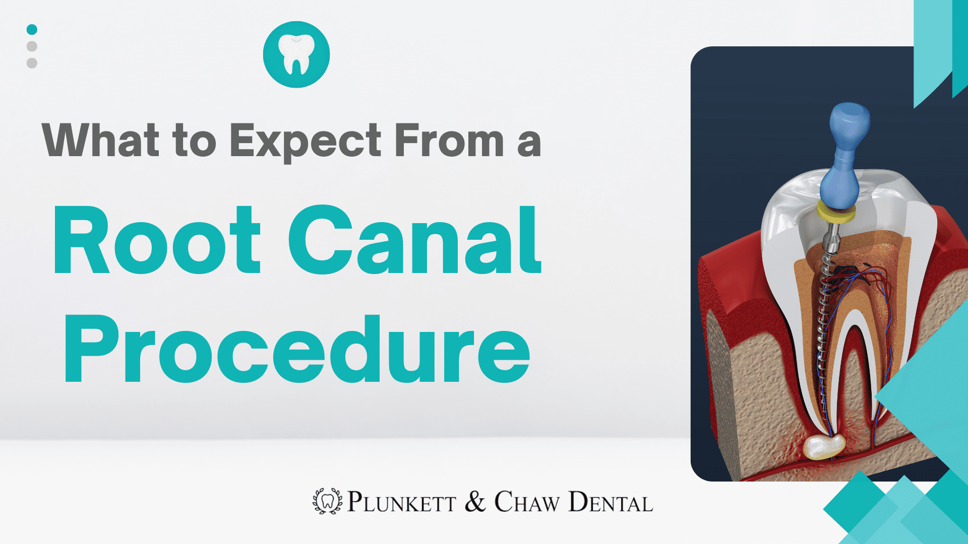 What to Expect From a Root Canal Procedure